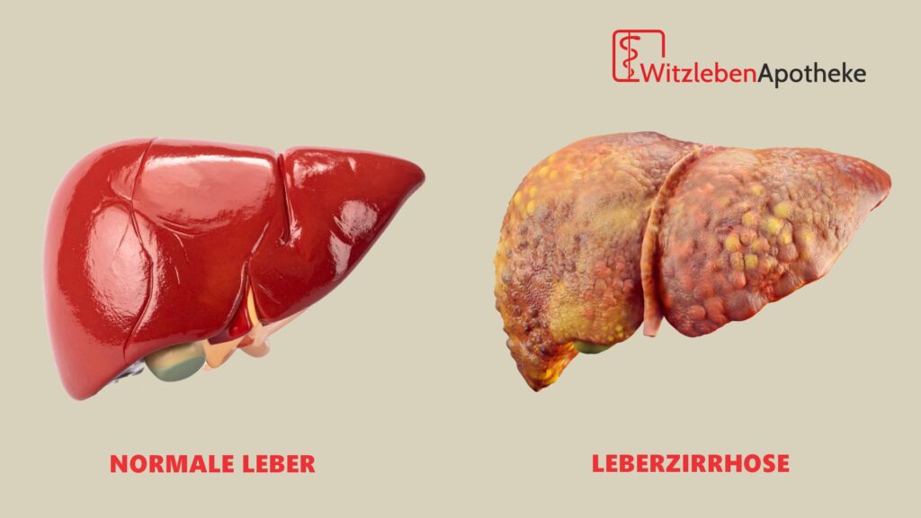 Gesunde Leber und Leberzirrhose gegenüber gestellt